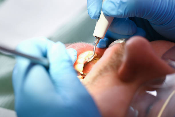 Best Emergency Dentist for Knocked-Out Tooth in Russiaville, IN