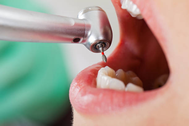 Best Emergency Dental Extractions in Russiaville, IN